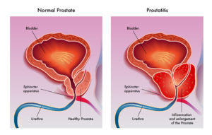 Two Prostate Images Med Pic