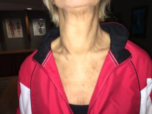 Lymphatic System Swelling in Neck 3