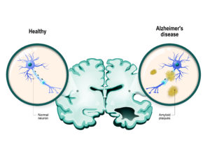 Alzheimer's disease. Aggregation of proteins, Amyloid Buildup