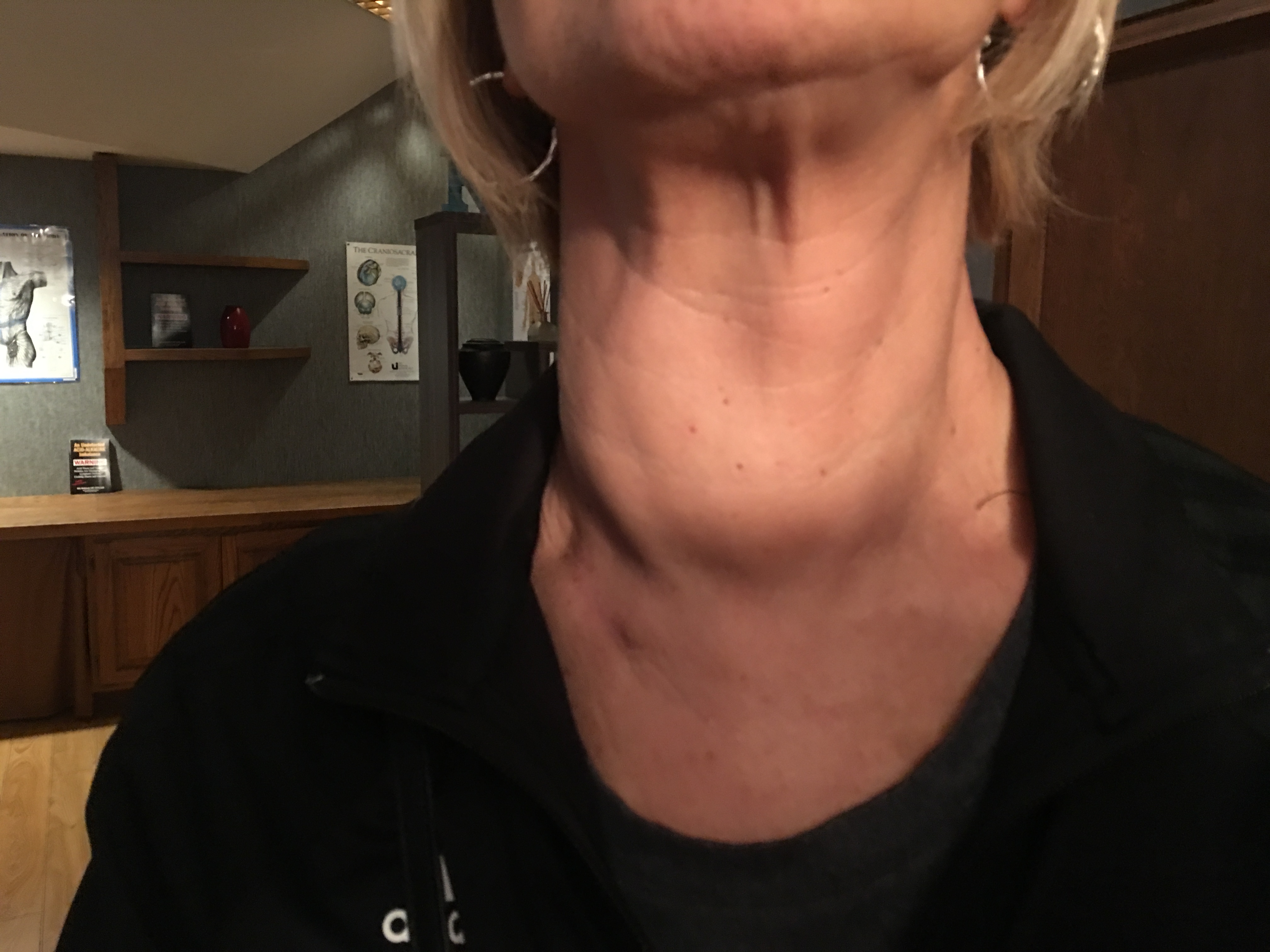 back of neck swollen lymph nodes