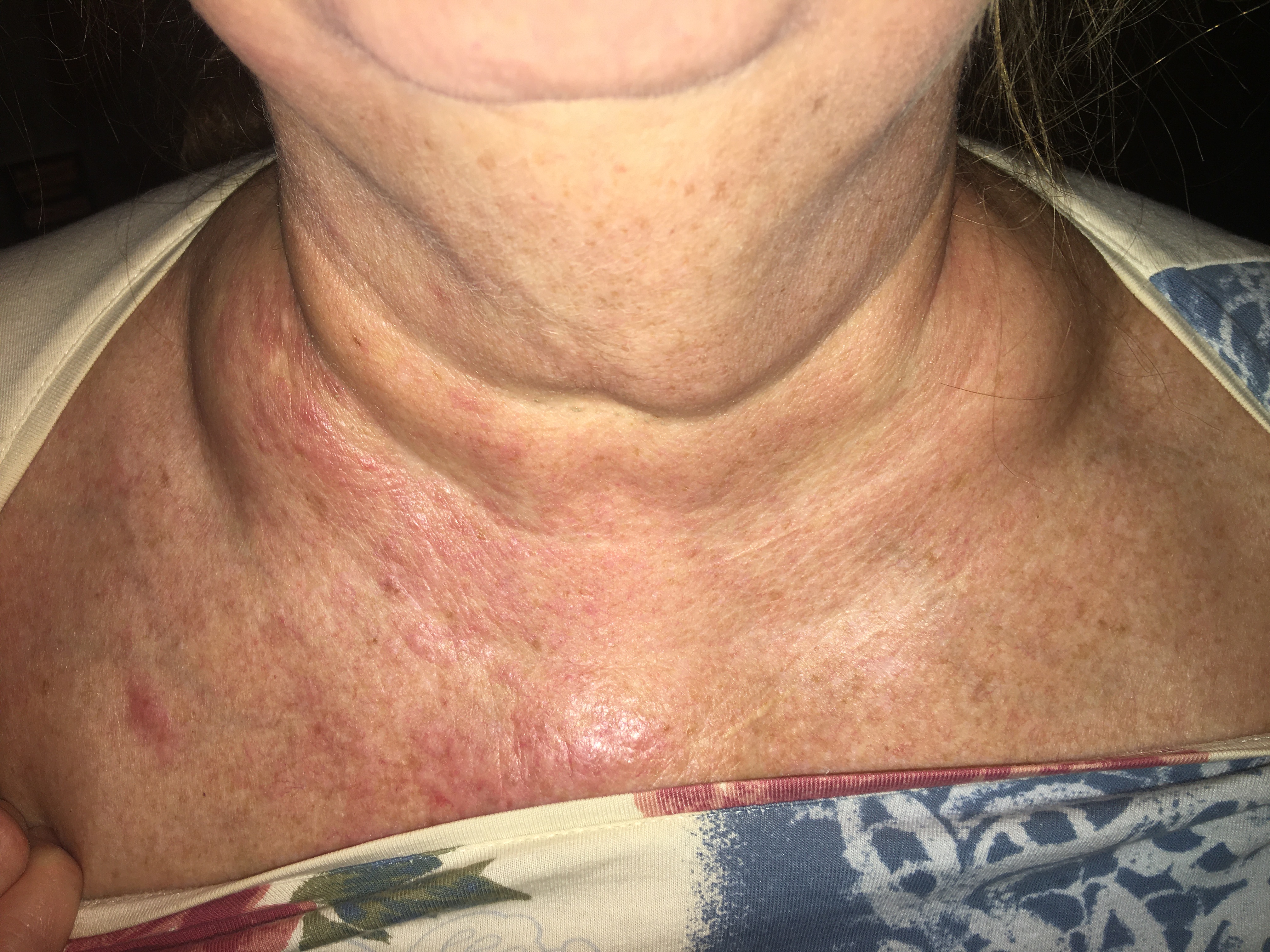 swollen supraclavicular lymph nodes due to infection